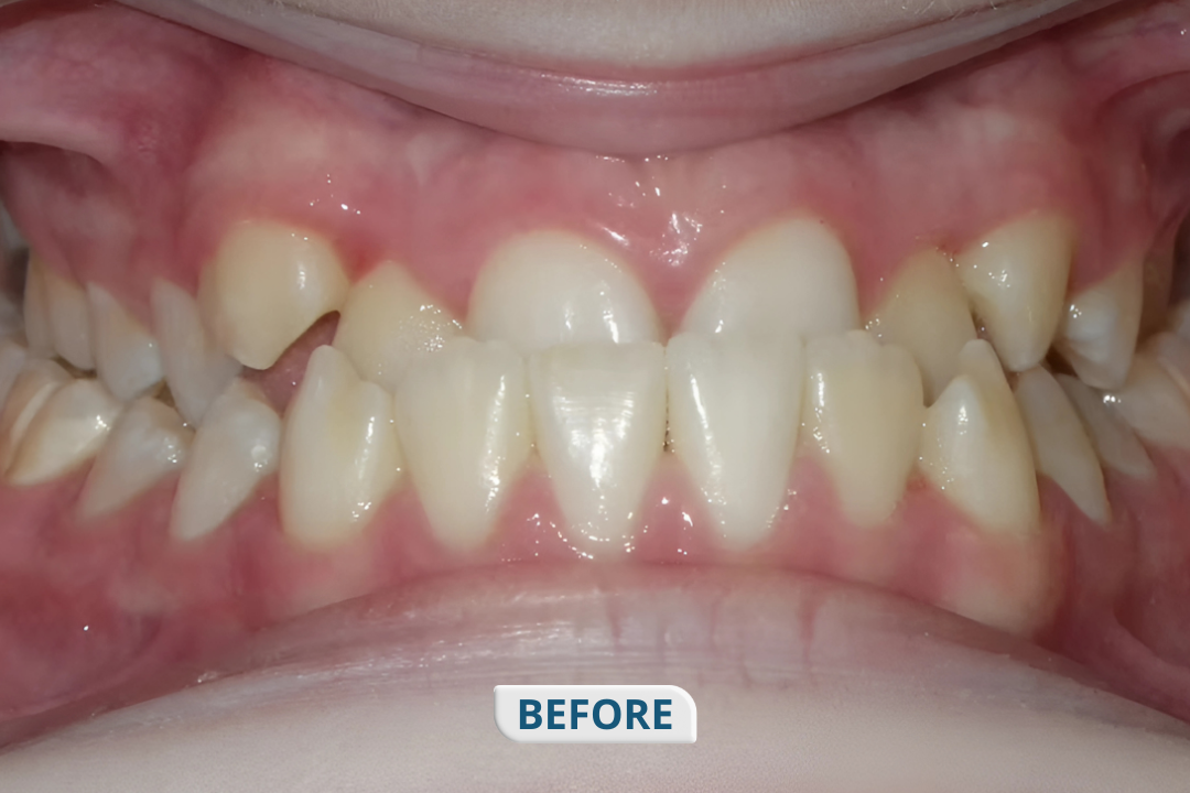 Before treatment at Namira Oro Dental Care